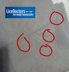 Four small nits on paper towel - LiceDoctors