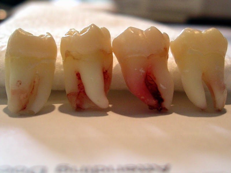Wisdom-Tooth-Extraction3