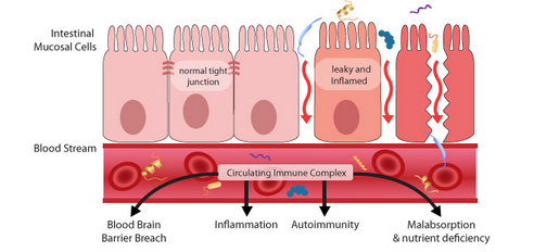 Do You Have "Leaky" Gut?