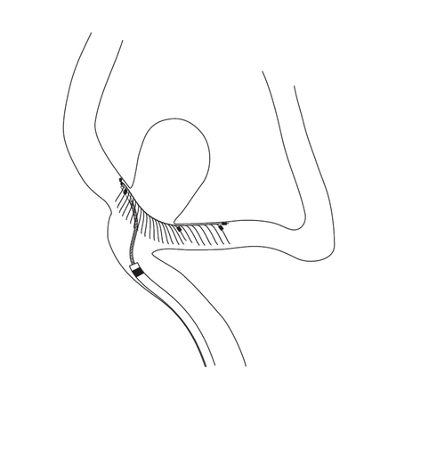 eCLIPs Medical Devices for Cerebral Aneurysm