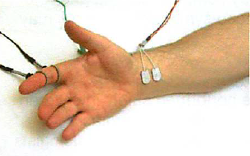 Nerve conduction studies (NCS) and electromyography (EMG) – Treatments ...