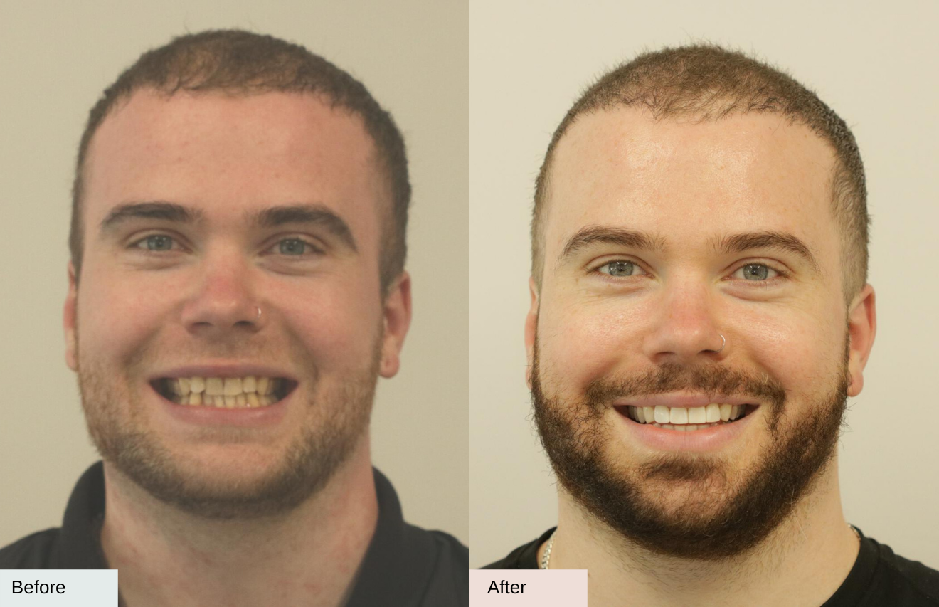 Invisalign before and after