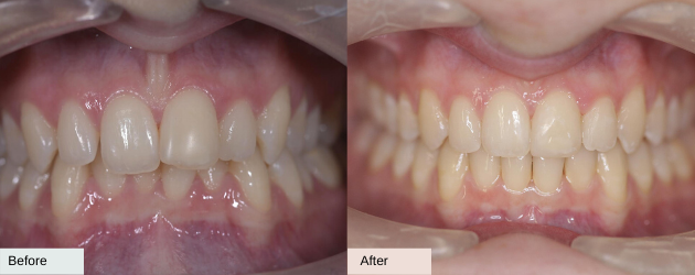 Before and after invisalign overbite