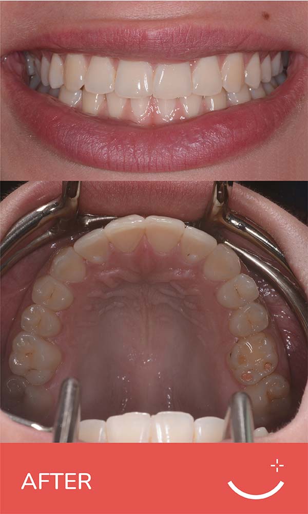 Clear Retainers Best Clear Teeth Retainers in Dubai, Abu Dhabi