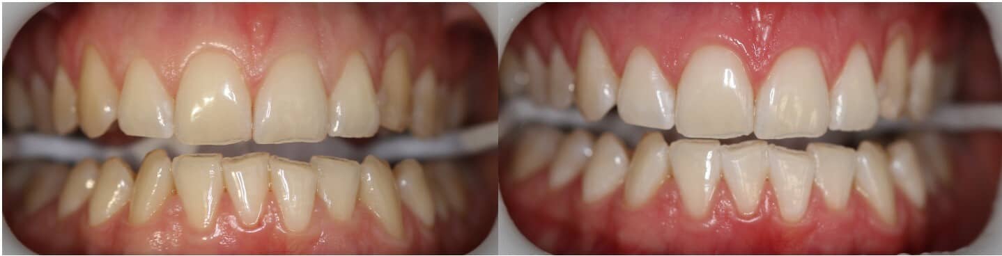 Vorher Nachher Bild eines Bleaching Resultates
