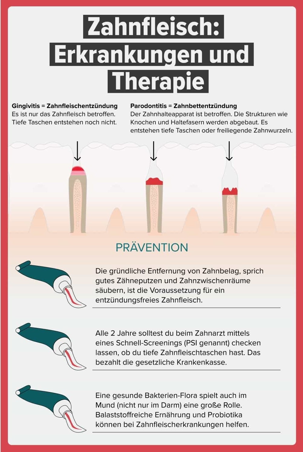 Unterschied zwischen Zahnfleischentzündung und Parodontitis erklärt