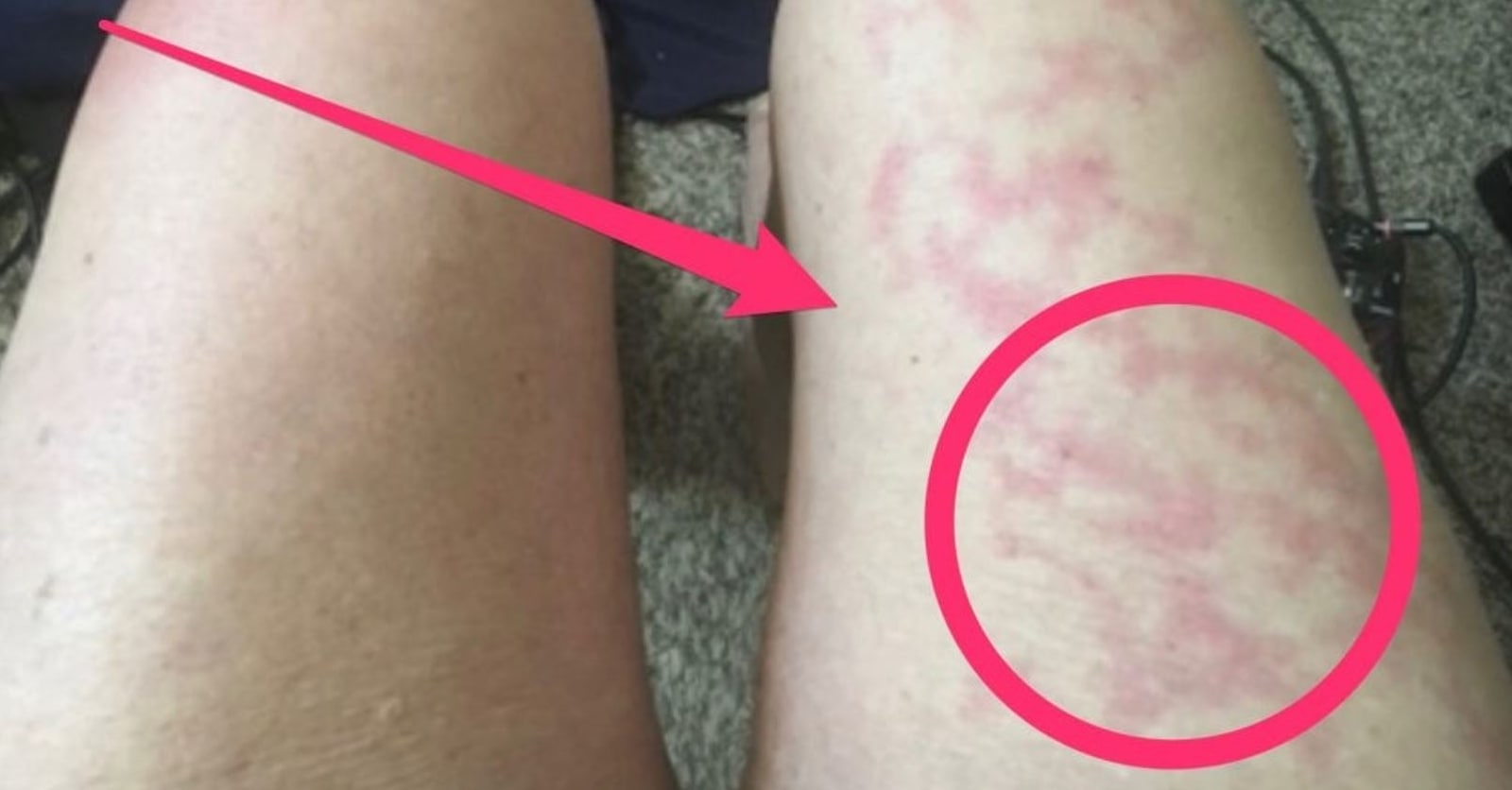 How to Get Rid of Hives after COVID19 Laredo Emergency Room