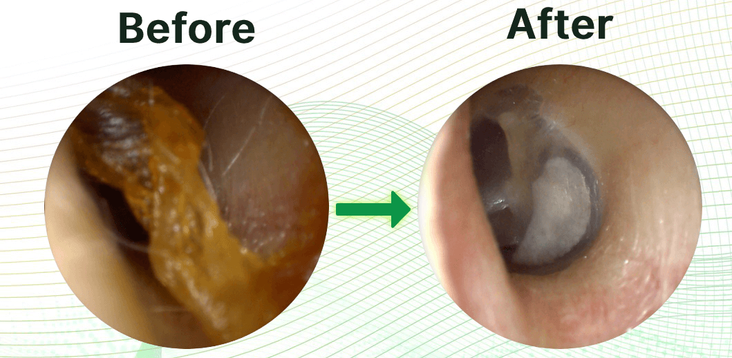 Earwax Removal In Clinton Township Mi Hearnow Earwax Removal In Clinton Township Mi Hearnow