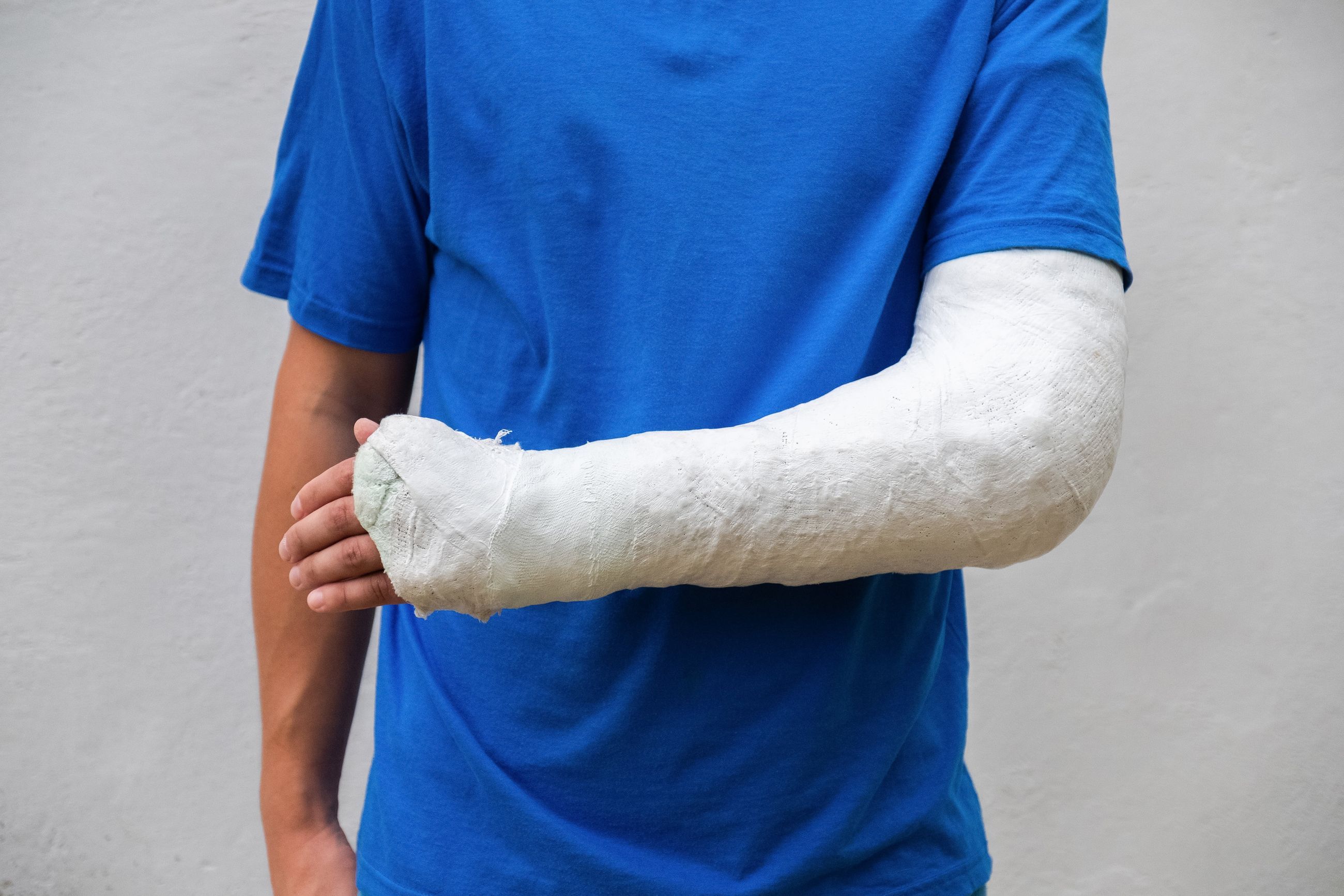 How Plaster Casts are Used to Treat Fractures