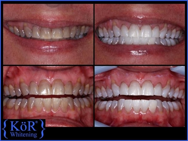 KOR System of teeth whitening