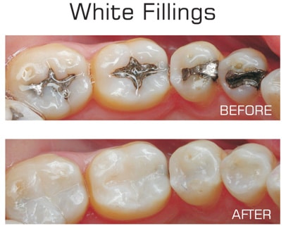 Types of fillings
