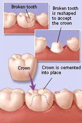 Dental Crowns/Caps