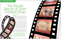 Tooth Colored Fillings