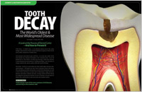 Tooth decay