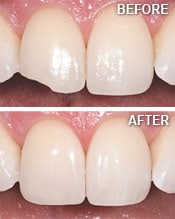 Tooth bonding, before and after images