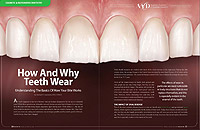Why do your teeth wear out so fast?