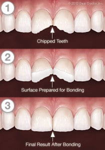 Tooth bonding services