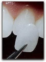 Patient fitting for veneer