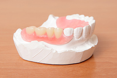 Dental Crowns & Bridges