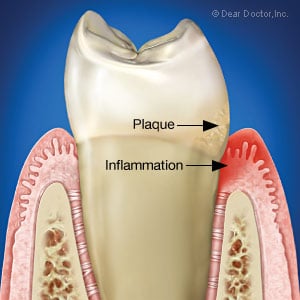 Example of Plaque and Gum Disease