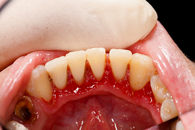 Gum Disease Treatment