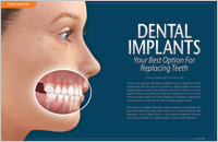 What are Implants? - Dear Doctor Magazine