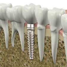 Root canal therapy and endodontics in Baton Rouge & Mandeville