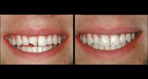 Broken & Displaced Tooth Care