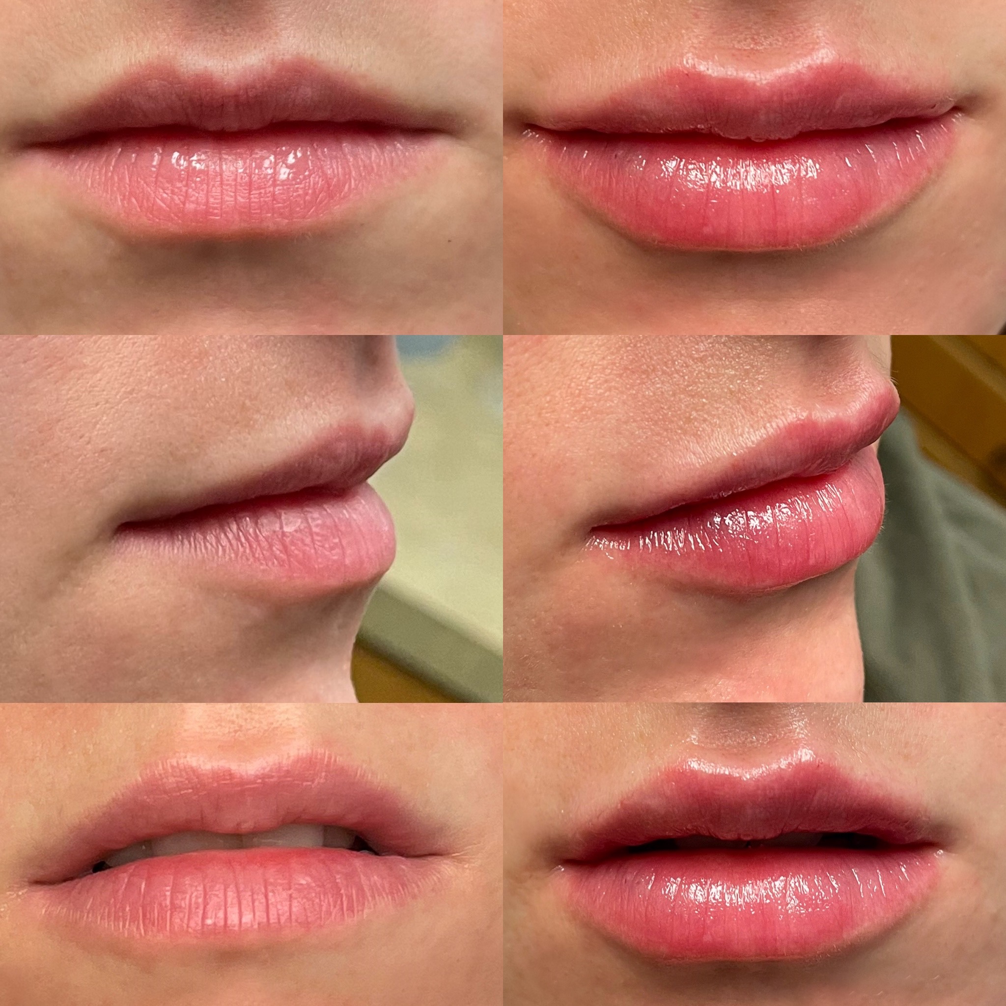 Lip Fillers