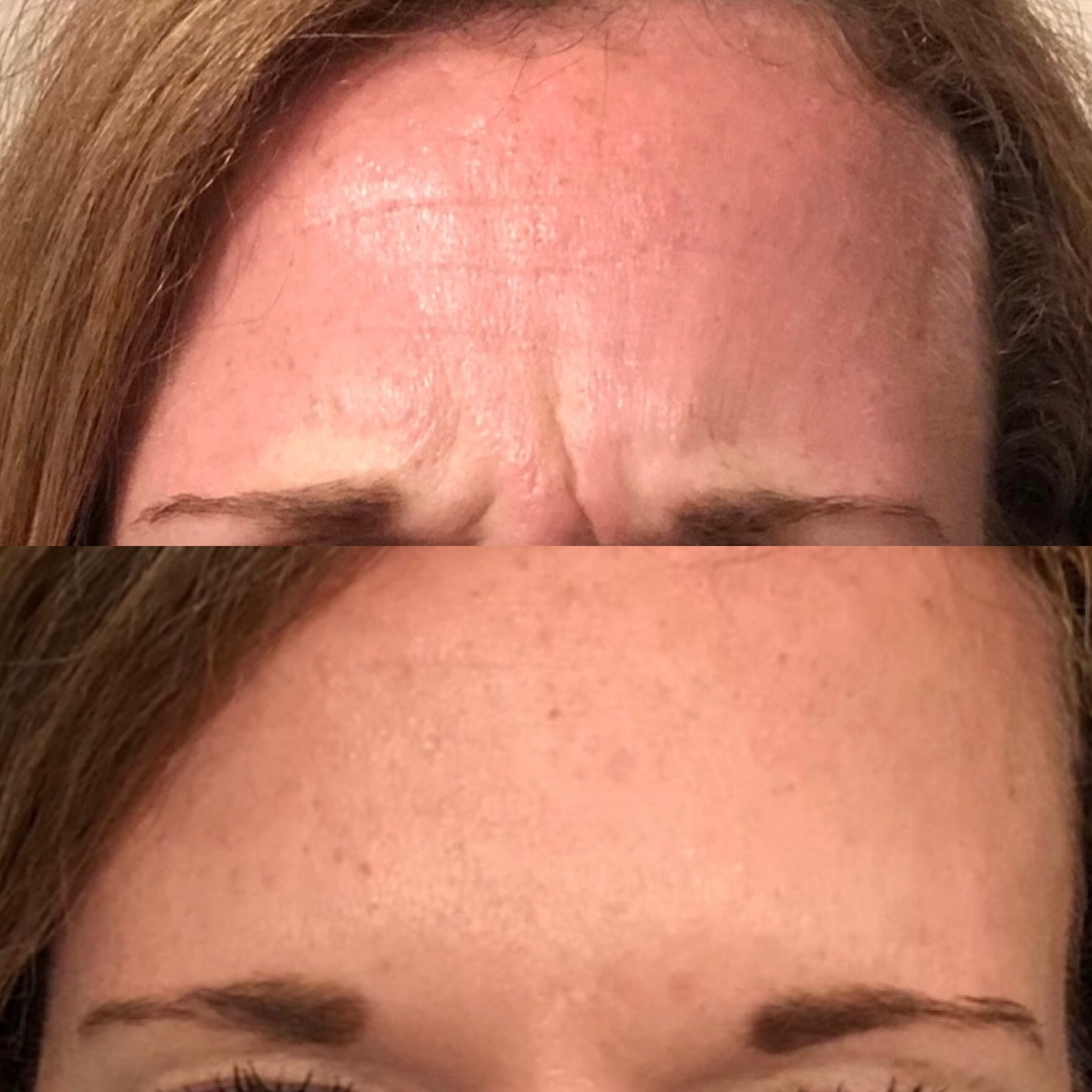Botox Forehead