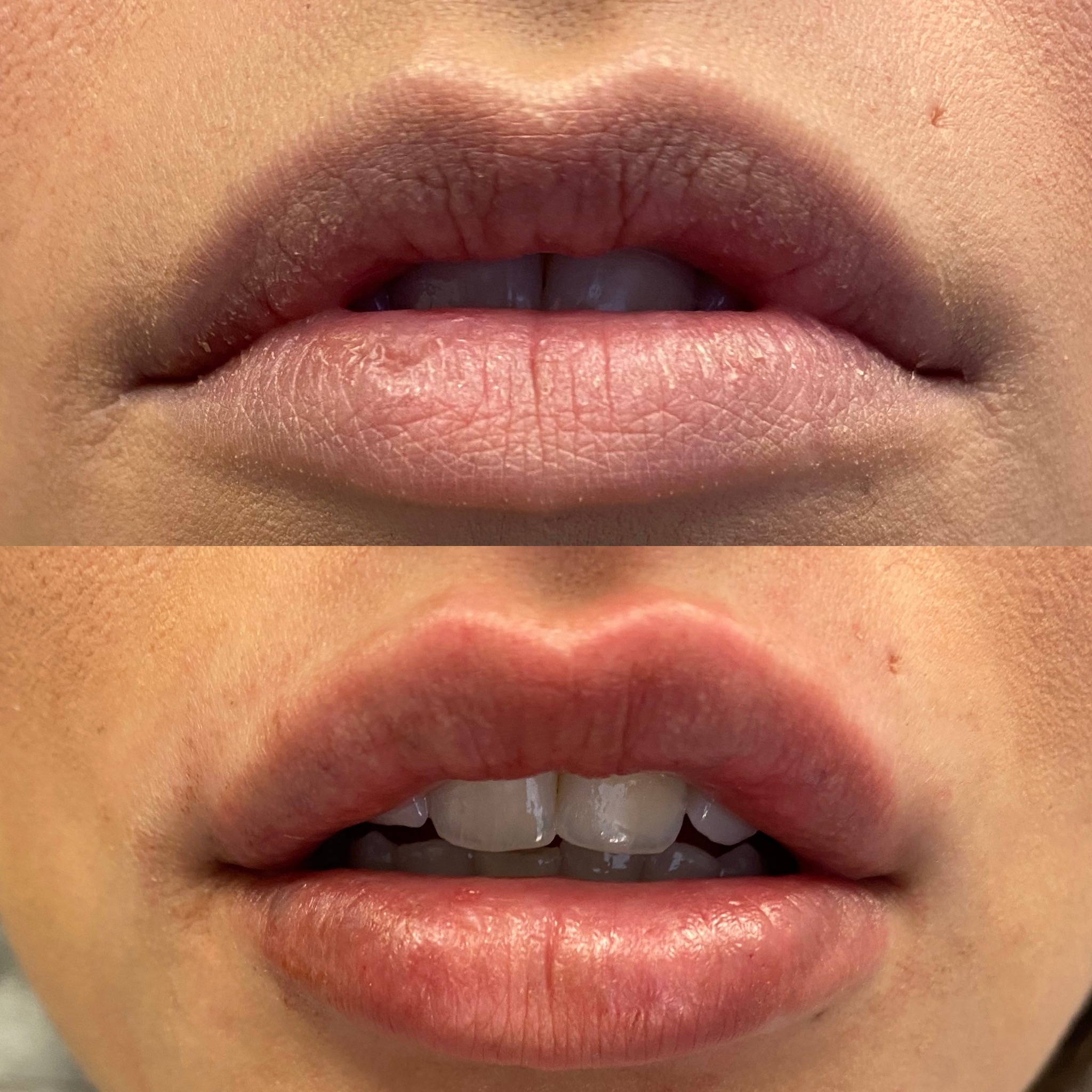 See the difference lip filler can make!