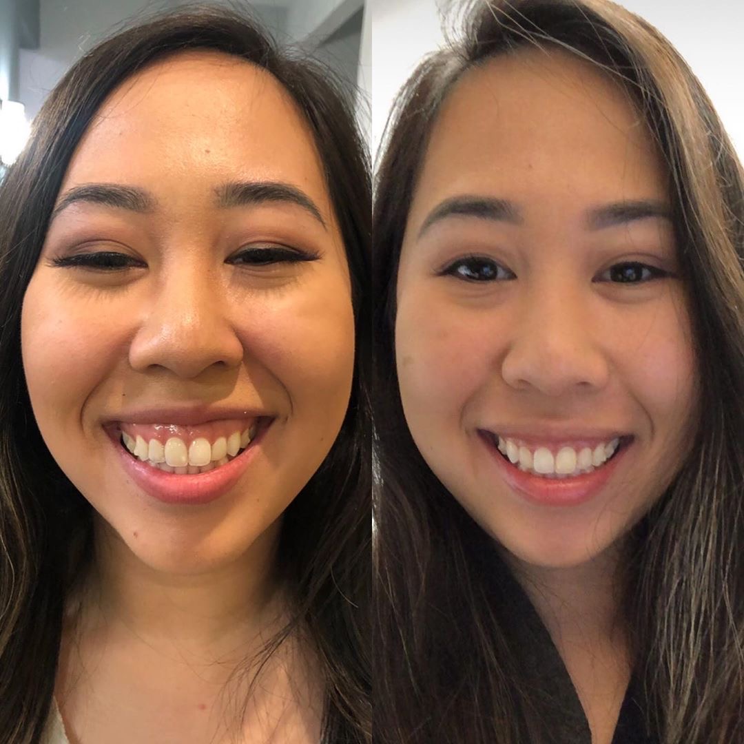 Injectible Lip Fillers