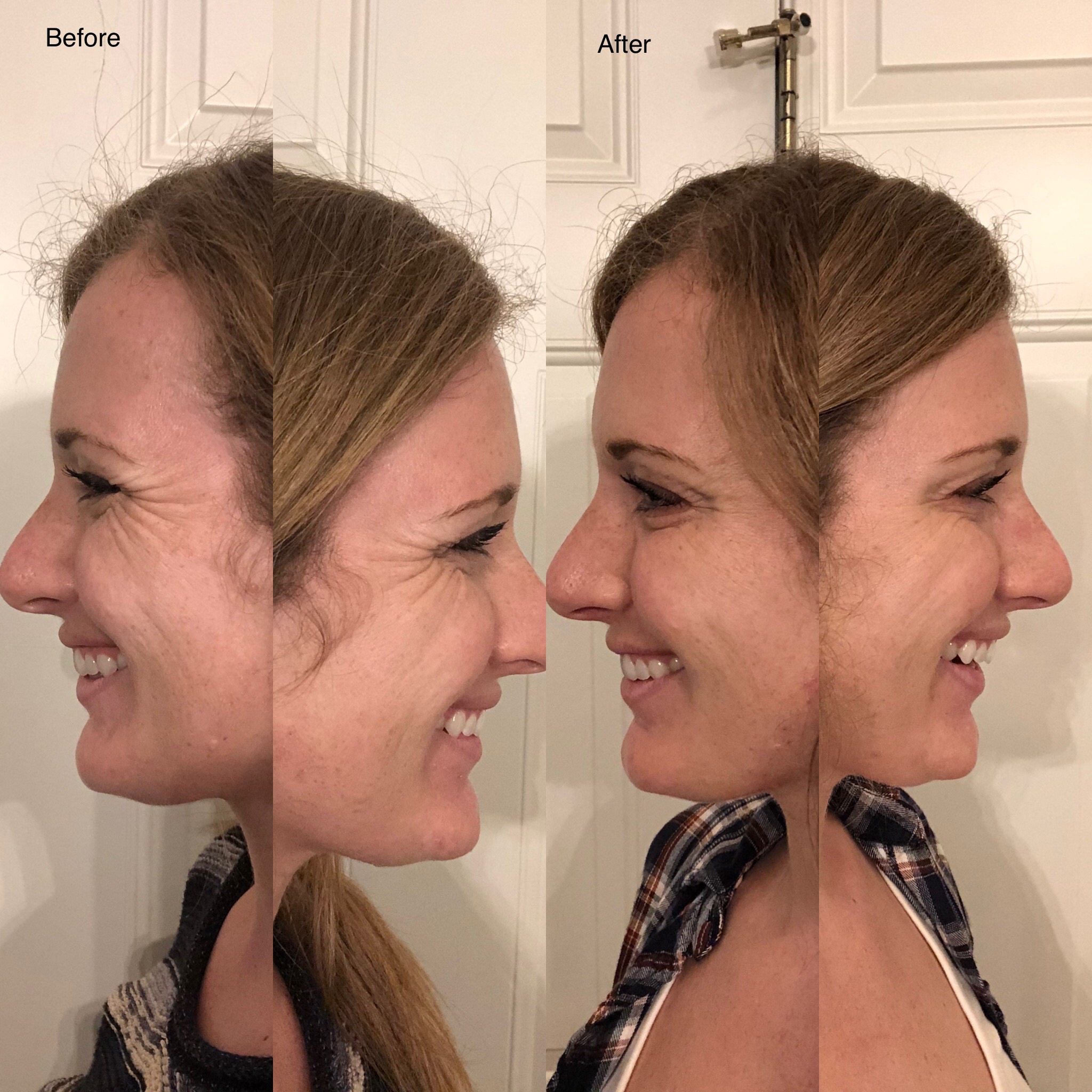 One of the target areas for botox is smile lines