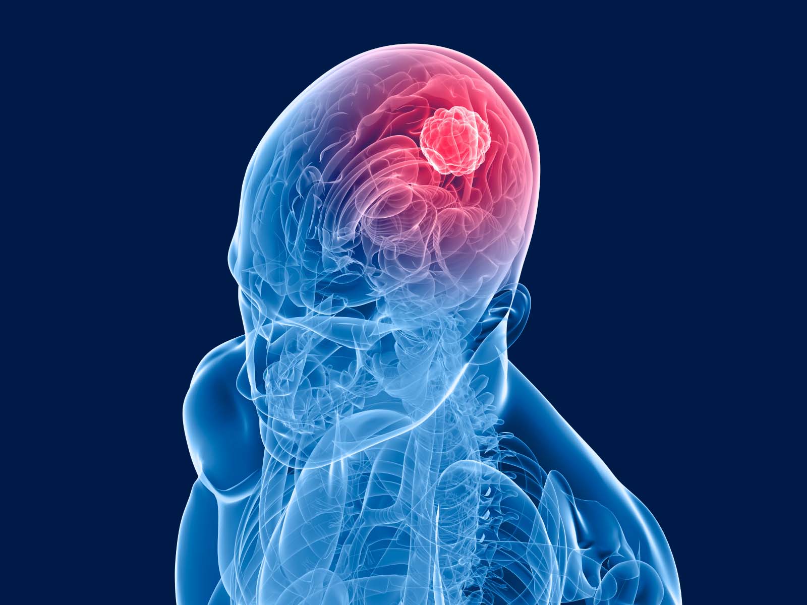 Illustration of brain tumor