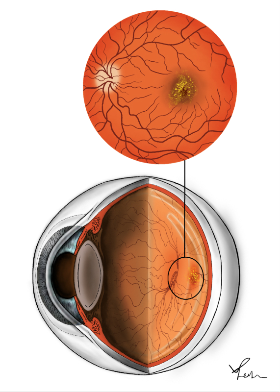 Dry ARMD illustration