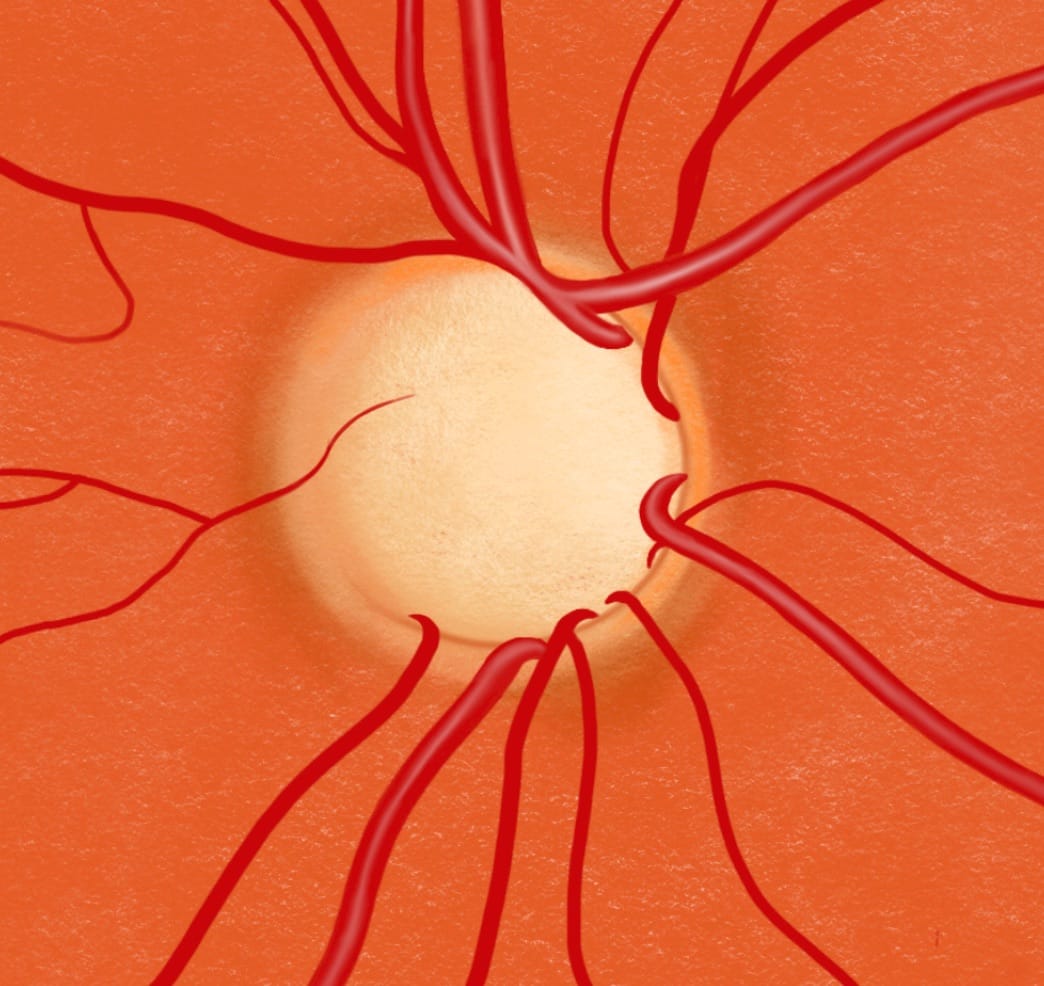 Optic nerve in glaucoma: the neuroretinal rim is thin because of nerve loss