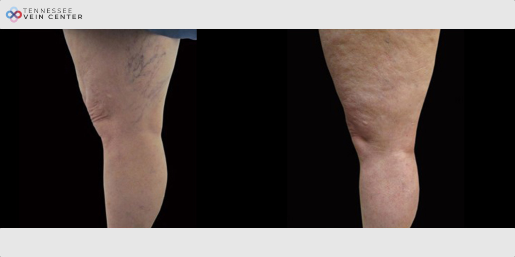 Spider Veins 1010