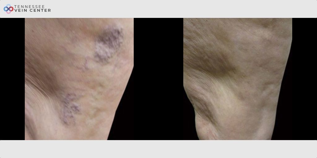 Spider Veins 1011