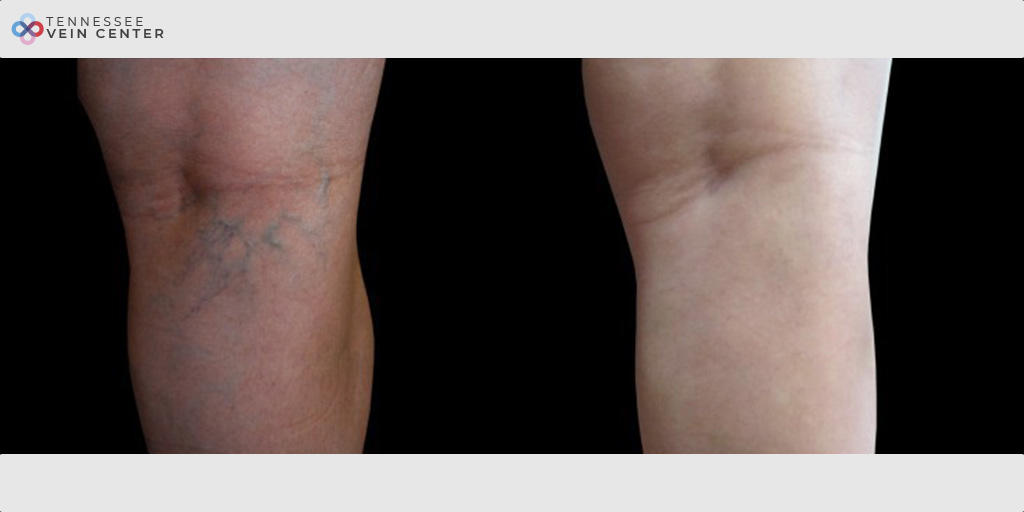 Spider Veins 1014
