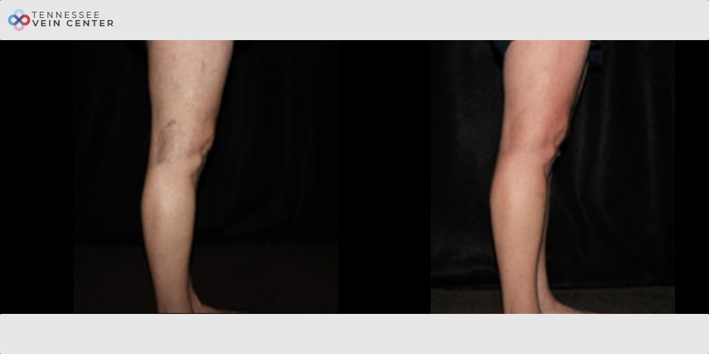 Spider Veins 1142