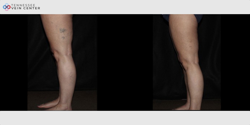 Spider Veins 1146