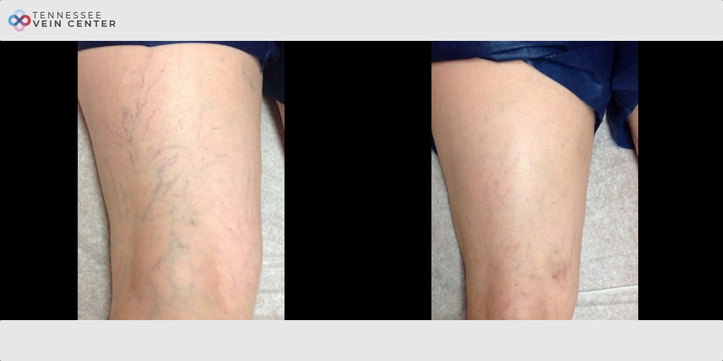 Spider Veins 1488
