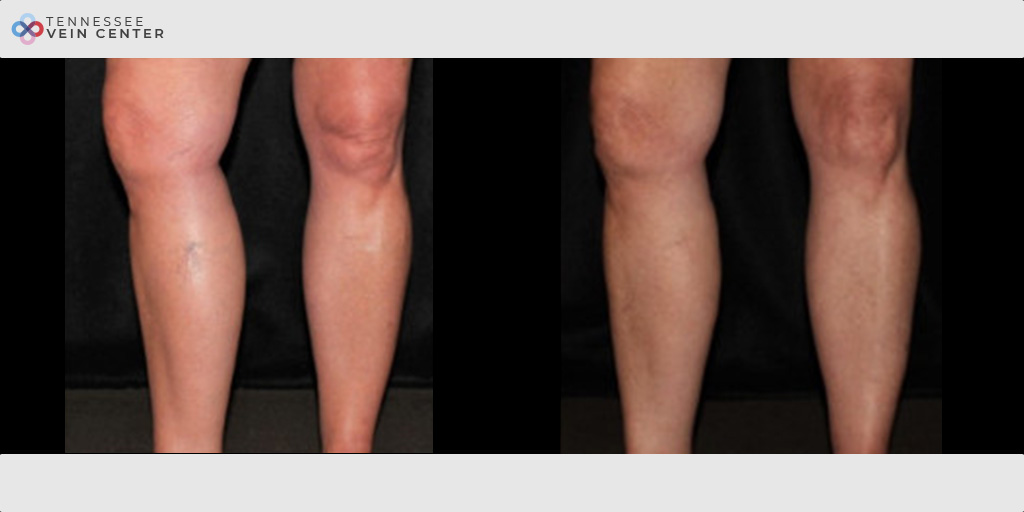 Spider Veins 1494