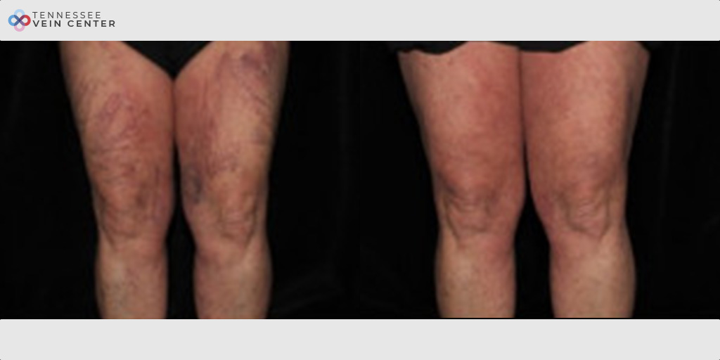 Spider Veins 1504