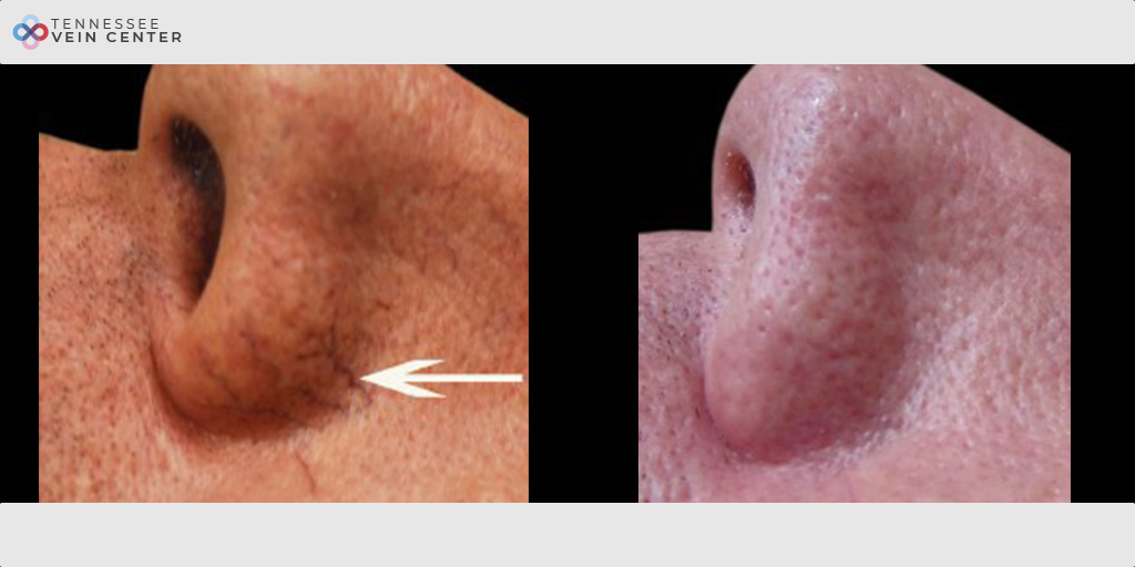 Face Veins 1006