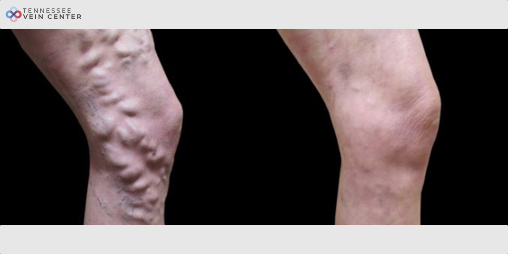 Varicose Veins 1027