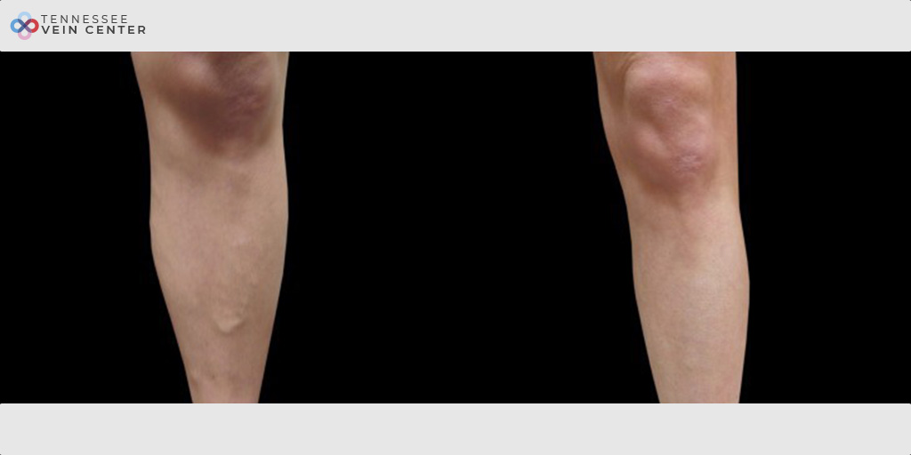 Varicose Veins 1028