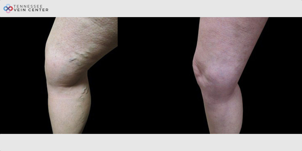 Varicose Veins 1030