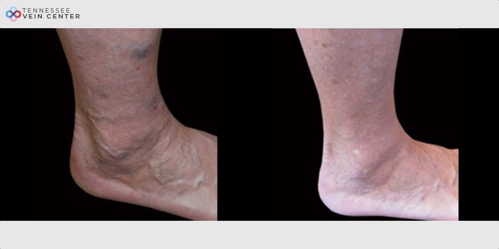 Varicose Veins 1031