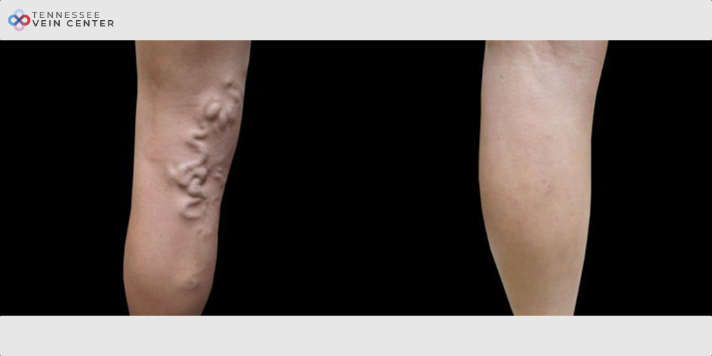 Varicose Veins 1034